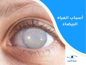 أسباب المياه البيضاء في العين.. متى يجب عمل عملية المياه البيضاء ؟