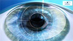 سعر عملية الفيمتو ليزك لتصحيح النظر