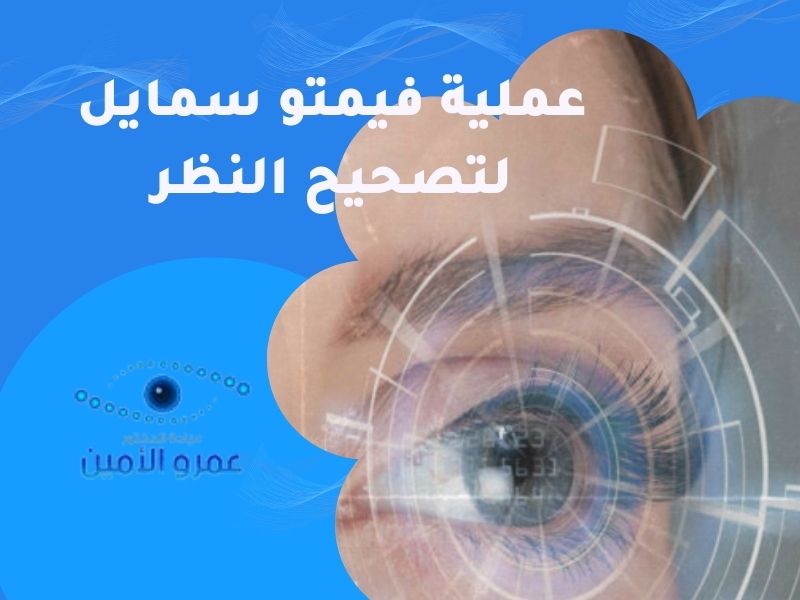 عملية فيمتو سمايل السحرية لتصحيح عيوب الابصار 2022