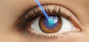 موانع عملية تصحيح النظر بالليزر: دليل طبي شامل 2026 24 أفضل عملية تصحيح نظر نتائجها مضمونة