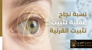 نسبة نجاح عملية تثبيت القرنية